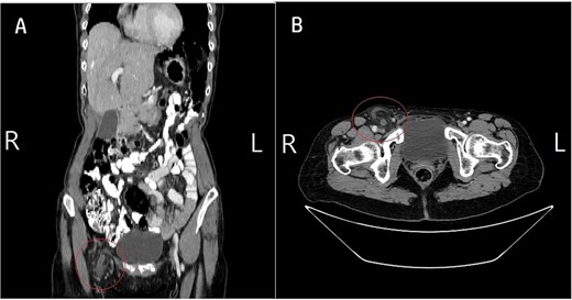 Contrast-enhanced CT scan confirming strangulated AH. (A) Axial view: CT shows the right inguinal hernia sac containing the dilated appendix (1 cm diameter). Note the significant periappendiceal fat stranding and adjacent fluid, confirming acute appendicitis. (B) Coronal view: CT clearly demonstrates the inflamed appendix and omental fat descending from the right lower quadrant and entering the right inguinal canal. The images collectively showed no enhancement of the herniated contents, consistent with vascular compromise and strangulation.
