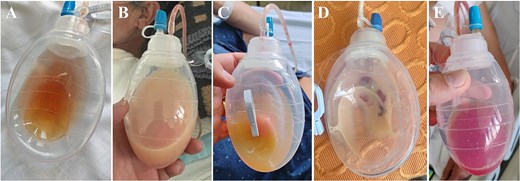 Evolution and aspect of the drainage content throughout the hospitalization. During the first days after the carotid subclavian bypass and TEVAR, a citrine serohematic fluid was identified in the drainage collector (A). Then, 24 hrs after reinitiating oral intake, the drainage turned to a milkier aspect with an increase in the daily output (B). Once confirmed the chylous etiology (after the fluid analysis) dietary fat restrictions and octeotride were initiated. The drainage fluid recovered its previous citrine aspect associated with a daily output decrease (C). Due to the initial response to conservative measures, the oral intake of fat was reintroduced and the fluid drainage turned again into a milky dense fluid (D). Due to this, conservative measures were considered insufficient and surgical reexploration with indocyanine-green assistance was performed. After the surgical ligation of the chyle-leak, the drainage fluid aspect turned serohematic with low output within the first postoperative 24 hrs (E). The drainage was retrieved 48 hrs post chyle-leak ligation, and the patient was discharged.