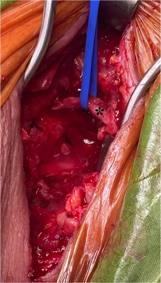 Reexploration of the cervical incision and surgical site. After the cervical fascia was reopened, the surgical bed was exposed, where it was identified a moderate content of the chyle fluid. The left yugular vein was controlled with vascular loops (asterisk) for anatomical reference. Two silk sutures are identified from the initial carotid-subclavian bypass surgery. After aspiration of the chyle fluid and tissue debridement, the vascular graft of the bypass was evidenced to be in contact with the chyle.