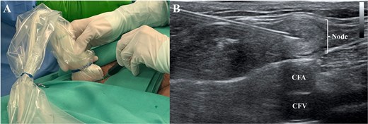 At the same time the cervical reexploration was being performed, the right inguinal area was prepared and under ultrasonographic guidance (A) using a 21G needle, an inguinal lymph node (B) was punctured and the indocyanine green was administered (0.2 mg/kg). CFA: Common femoral artery; CFV: Common femoral vein.