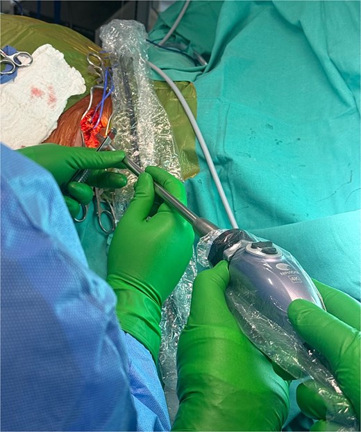 Forty minutes after the indocyanine green administration, the Hopkins® 0° NIR/ICG optic camera was directly situated and pointed into the surgical field.