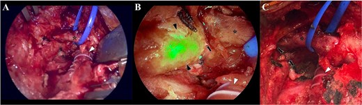 Camera view of the surgical field, without the near-red feature (A), where is depicted the bypass (arrowhead) and the left jugular vein (asterisk). Two visible silk sutures from the previous intervention are also identified. With the near-red feature (B), the thoracic conduct is clearly visualized due to the presence of the indocyanine-green (black arrowheads). This allowed to precisely identify that the leak came from thoracic duct (black arrow), in an anatomical position near the bypass (white arrowhead) and the left jugular vein (asterisk). Once the leak was identified, a clip ligation was performed with a metallic clip (C; black arrows) and the incision was closed in a standard fashion.