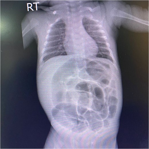 An anteroposterior abdominal X-ray of a male neonate shows marked gaseous distension of the abdomen with severe, diffuse dilation of numerous bowel loops. No evidence of pneumoperitoneum.