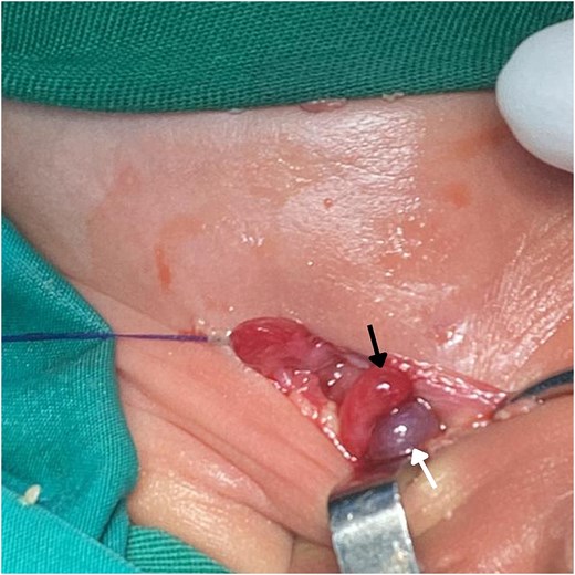 Intraoperative image shows the contents of an AH sac exposed during surgery. The hernia contains the viable cecum (black arrow) and a gangrenous appendix (white arrow).