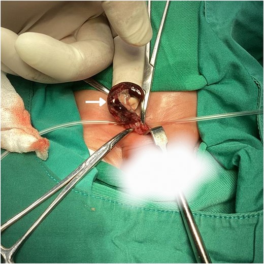 Intraoperative image shows the appendix (white arrow) enlarged and inflamed, with clear areas of gangrenous necrosis.