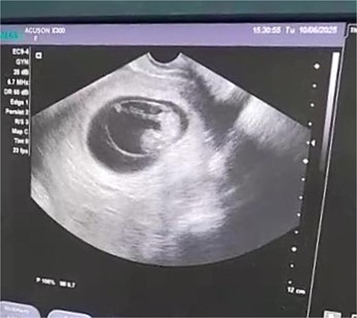A grayscale transvaginal ultrasound image displayed on a monitor. The scan shows a well-defined, dark (anechoic) gestational sac within the uterus. Inside the sac, a 10-week-old embryo is visible with a discernible fetal pole. The surrounding uterine tissue and the interface of the ultrasound probe are visible in the scan area.