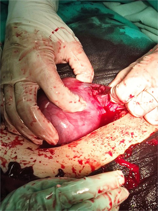 An intraoperative photograph showing a surgical field during a laparotomy. A pair of gloved hands is holding a congested, enlarged uterus. A rupture is visible in the left interstitial (cornual) region of the uterus, with active bleeding and dark red blood clots (hemoperitoneum) surrounding the organ in the pelvic cavity.