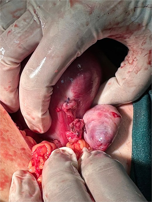 An intraoperative photograph showing the uterus after surgical repair. The left interstitial rupture site has been closed with visible dark-colored sutures. The left fallopian tube has been removed (salpingectomy site), and the surgical field appears clean with successful hemostasis. A pair of gloved hands is carefully positioning the uterus to display the integrity of the repair.