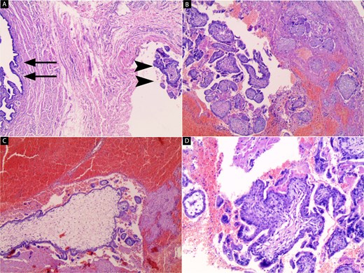 A composite of four photomicrographs (A-D) of histopathological sections stained with Hematoxylin and Eosin (H and E).(A) A low-magnification view (40x) showing a fallopian tube section with the lumen indicated by arrows and chorionic villi embedded within the muscular wall, marked by arrowheads.(B) and (C) show low-magnification views (40x) of chorionic villi surrounded by extensive red-stained areas of fresh hemorrhage and blood clots within the tubal wall.(D) A higher magnification view (100x) focusing on the chorionic villi, showing their characteristic structure lined by trophoblastic cells against a background of scattered blood cells.