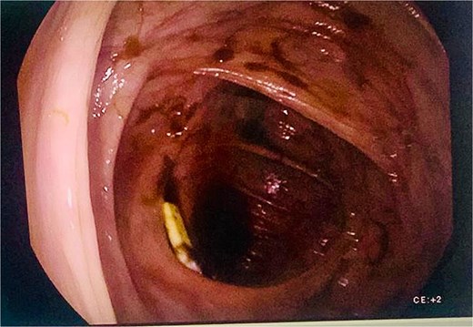 Colonoscopy shows the tip of the drain within the cecum, surrounded by blood clots.
