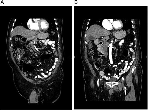 (A) CT, the drain is seen within the colon. (B) CT, no free air or fat stranding is seen around the colon or drain.