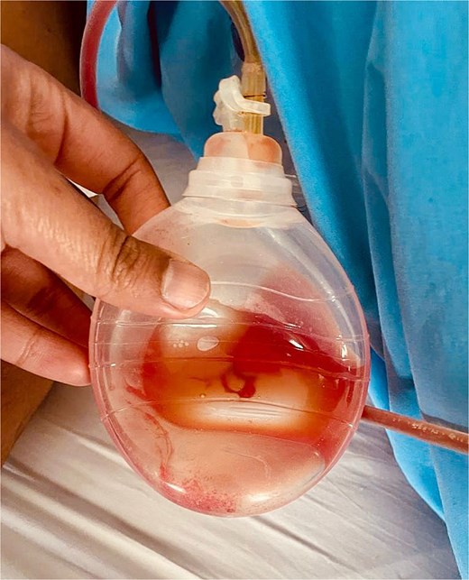 Bulb of the drain with serous output.