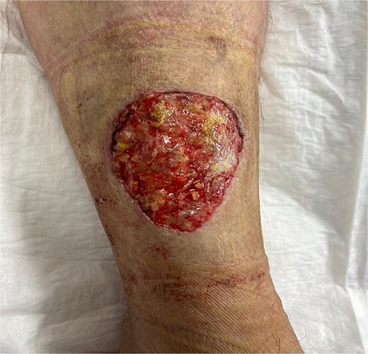 Wound-large skin and subcutaneous defect on the distal-lateral aspect of her right lower leg.