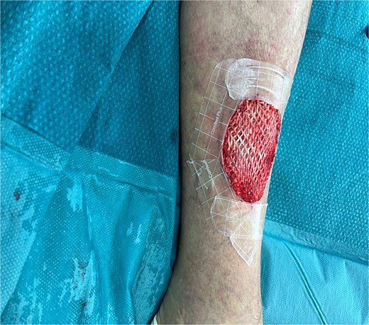 Application of Kerecis graft.