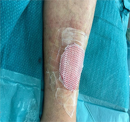 Application of a Mepitel spacer grid.