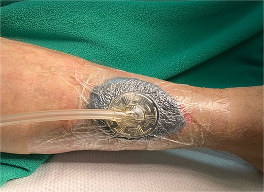 Application of a NPWT.