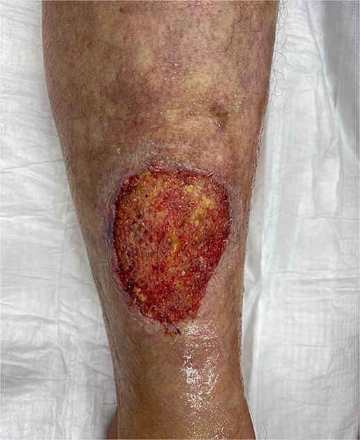 Wound assessment three days postoperatively, following removal of the VAC dressing: Showing a partially integrated Kerecis fish skin graft with beginning granulation and without any signs of infection.
