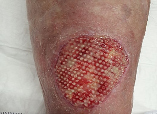 Four weeks postoperatively.