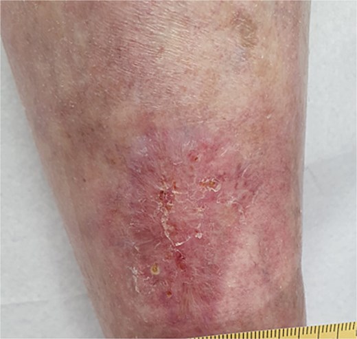 Wound closure after 10 weeks.