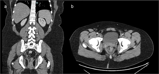 Contrast-enhanced CT of the pelvis. (a) Axial image demonstrating inflammatory stranding and perirectal fluid with foci of extraluminal air adjacent to the posterior rectum. (b) Coronal image showing disruption of the posterior rectal wall with associated soft tissue changes extending into the presacral space.