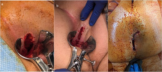 Intraoperative findings and repair of traumatic rectal injury. (a, b) Examination under anesthesia demonstrating the extent of the posterior rectal laceration, involving ~25% of the rectal circumference with disruption of the internal sphincter. (c) Final appearance following overlapping sphincteroplasty with interrupted 2-0 Vicryl sutures, showing restored sphincter continuity and healthy tissue margins.