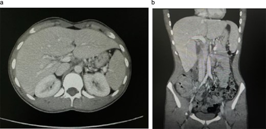 CT images showing a liver lesion in segment 4B and thickening of the right colon, suggesting possible colon cancer with liver metastasis.