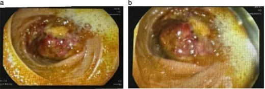 Colonoscopy images showing a large ulcerated cecal mass consistent with gastrointestinal basidiobolomycosis.