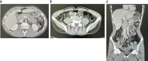 Follow-up CT images showing resolution of liver lesions and normalization of the right colon, indicating excellent response to antifungal therapy.