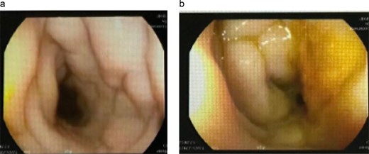Colonoscopy images showing narrowing and abnormal mucosa of the rectosigmoid colon consistent with gastrointestinal basidiobolomycosis.