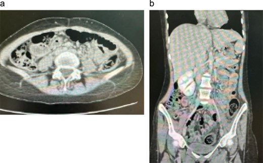 Follow-up CT images showing resolution of rectosigmoid and peritoneal disease, indicating favorable response to antifungal therapy.