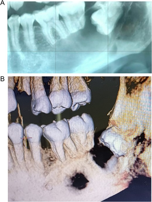 Preoperative imaging studies. (A) Panoramic radiograph. (B) Cone beam computed tomography.