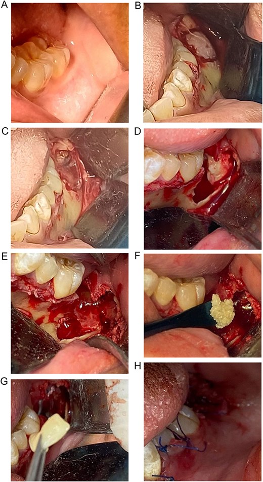 Sequence of images showing the surgical management of a mandibular dentigerous cyst, including elevation of a mucoperiosteal flap, removal of the cystic lesion with extraction of the impacted molar, placement and compaction of an autologous tooth graft, application of fibrin-rich plasma, and closure of the surgical site.
