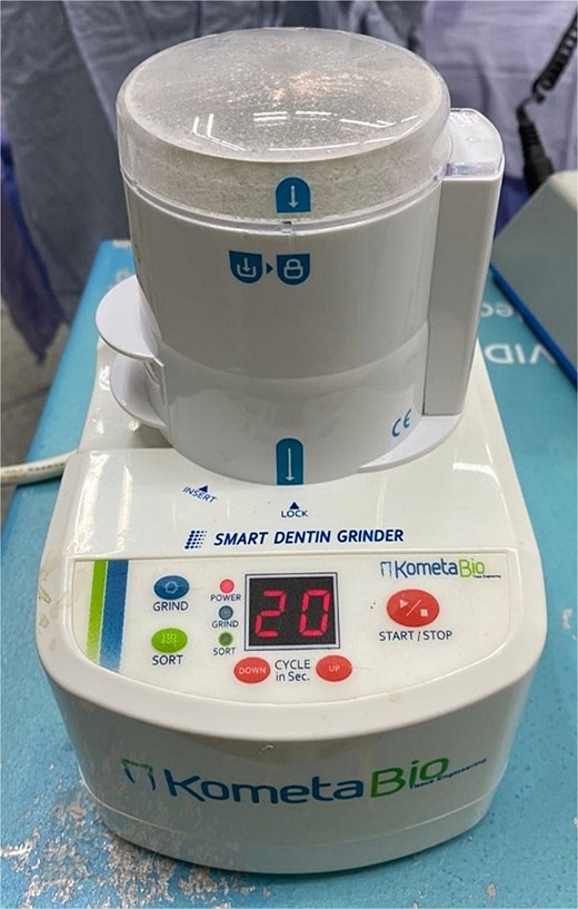 KometaBio device used to grind extracted teeth and generate particulate material for the preparation of autologous tooth graft.