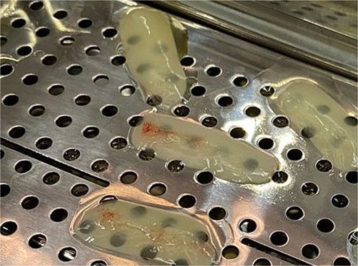 Platelet-rich plasma clots intended for use in surgical sites, placed on a metal tray prior to their application over the bone graft.