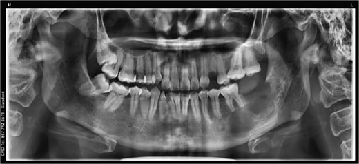 Panoramic radiograph showing the mandibular region after complete removal of the cyst and reconstruction of the bone defect.