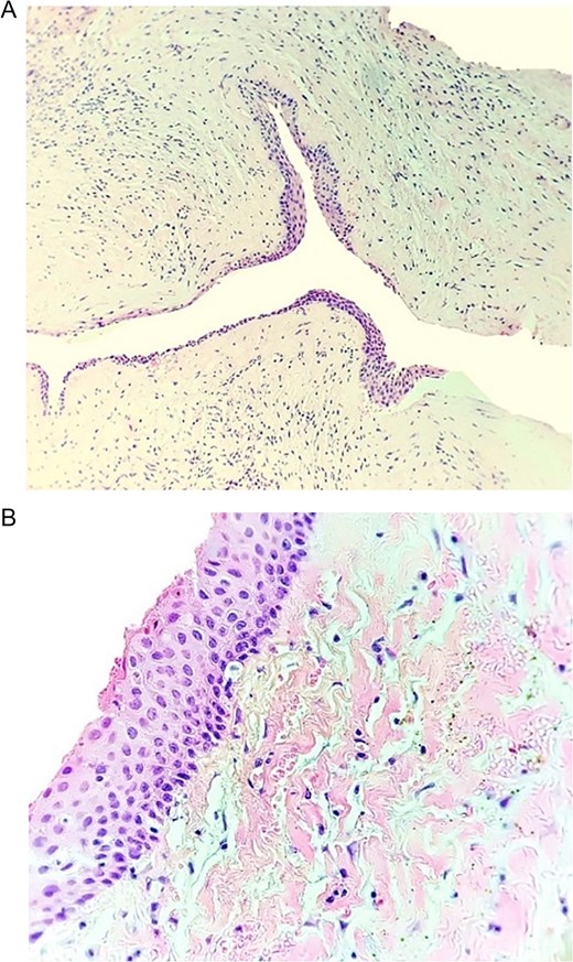 Histopathological image of a dentigerous cyst showing a cystic cavity lined by non-keratinized stratified squamous epithelium, fibrous connective tissue, and mild inflammatory infiltrate.