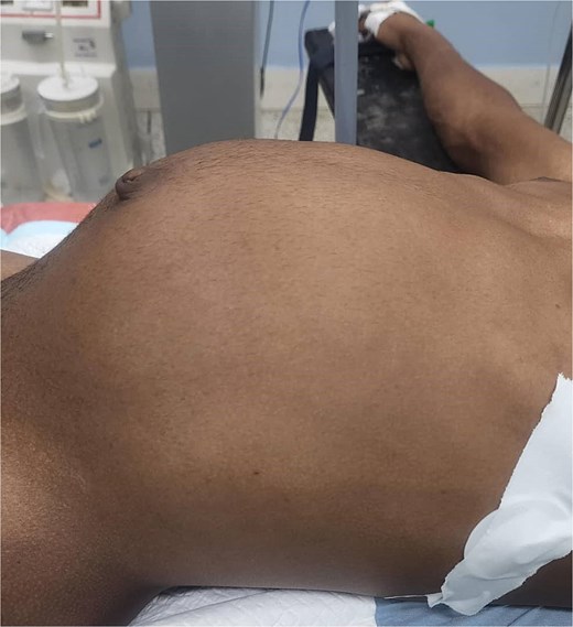 A large, palpable smooth mass measuring ~20 cm in diameter.