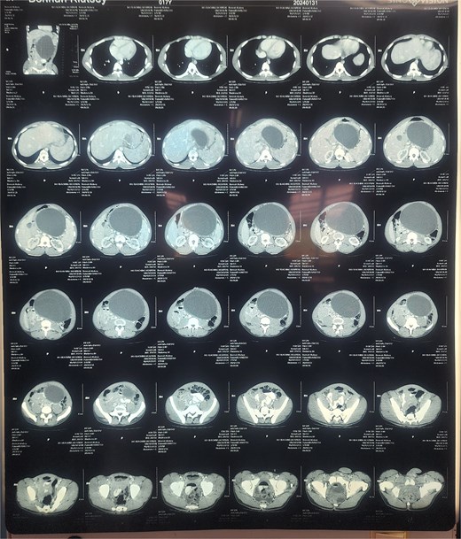 Contrast-enhanced CT scan of the abdomen demonstrating an 18.5 × 10.0 × 13.5 cm well-circumscribed, unilocular pancreatic cyst lesion in the region of the body and tail of the pancreas.