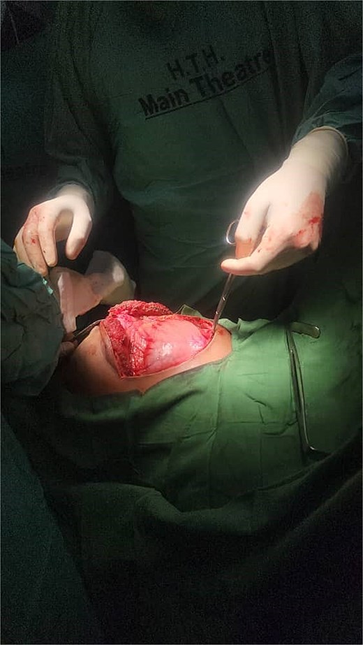 Intraoperative photograph during exploratory laparotomy. The image shows the exposed pancreatic pseudocyst in the upper abdomen, confirming the preoperative diagnosis.