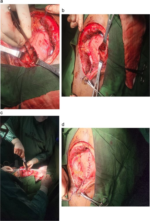 Intraoperative photographs of the transgastric cystogastrostomy procedure. (a) Large cystic mass identified in the lesser sac after midline laparotomy. (b) Anterior gastrotomy exposing the posterior wall of the stomach. (c) Evacuation of ~2850 mL of pseudohemorrhagic fluid from the opened pseudocyst. (d) Completed side-to-side anastomosis between the posterior wall of the stomach and the anterior wall of the pseudocyst, using Vicryl 2-0 sutures in a continuous fashion.