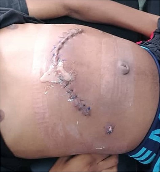 Surgical site at 11 days post-surgery, showing local abscess formation indicative of surgical site infection.