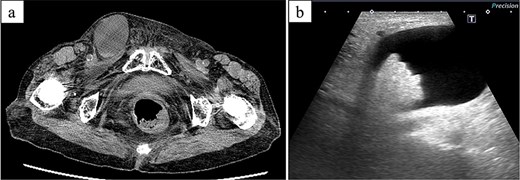 CT and ultrasonographic findings. (a) CT image showing a 4-cm right inguinal hydrocele. (b) Ultrasonography showing protruding fatty tissue within the hydrocele.