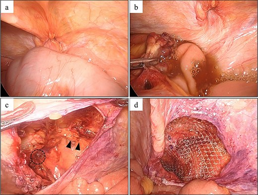 Laparoscopic findings in Case 1. (a) AE of the transverse colon incarcerated in a right femoral hernia. (b) The AE was retracted from the hernia, after which clear ascites was released. (c) The round ligament of the uterus (arrowhead) and the femoral hernia orifice (circle) were identified. (d) Intraoperative image showing hernia repair using a 3DMax mesh (CR bard, Inc., Murray Hill, NJ, USA).