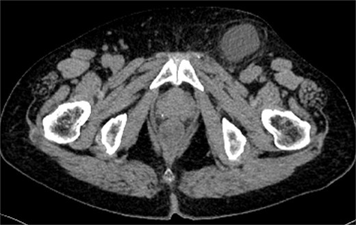 CT findings in Case 2. CT image showing a 4-cm left inguinal hydrocele.