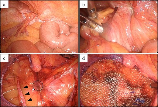 Laparoscopic findings in Case 2. (a) An AE of the sigmoid colon was incarcerated in a left femoral hernia. (b) The AE was retracted from the hernia, after which clear ascites was released. (c) The round ligament of the uterus (arrowhead) and femoral hernia orifice (circle) were identified. (d) Hernia repair using a 3DMax mesh (CR bard Inc., Murray Hill, NJ, USA).