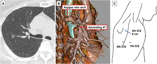 Preoperative imaging findings and surgical incision. (A) Computed tomography (CT) showing a 1.2-cm radiological part-solid lung nodule in the right upper lobe. (B) Three-dimensional CT imaging. (C) Surgical incision. ICS, intercostal space.