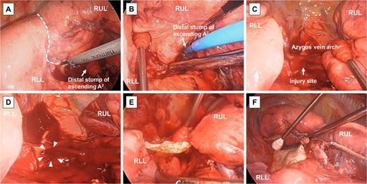 Surgical findings. (A) The interlobar fissure between the right upper lobe (RUL) and right lower lobe (RLL) (dotted line) is separated using an ultrasonic scalpel while compressing the bleeding point at the distal stump of the ascending A2. (B) Bleeding from the distal stump of the ascending A2 is controlled using soft coagulation. (C) The injury site of the azygos vein arch is temporarily sealed. (D) A 5-mm-diameter hole (white arrowheads) is observed at the injury site following mobilisation of the RUL, resulting in massive haemorrhage. (E) A fibrin sealant patch is applied to the injury site. (F) The surgical field after right S2 + S3a segmentectomy.