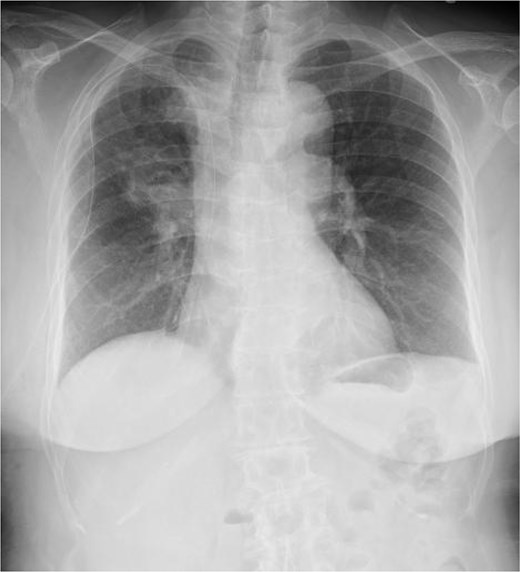 Postoperative chest radiography. A chest drain tube is placed in the right thoracic cavity, and no intrathoracic haematoma is observed.