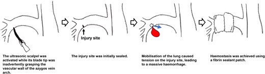 Surgical schema.
