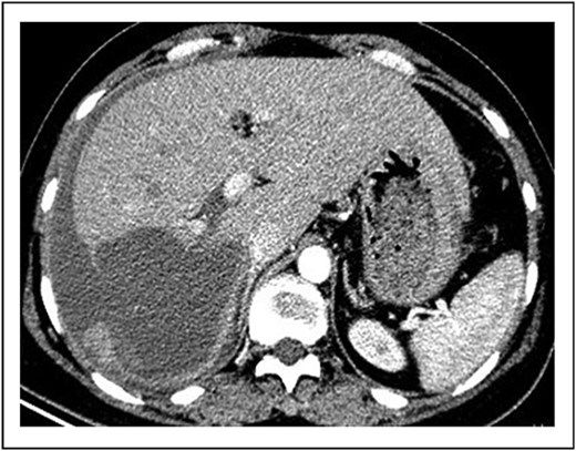 Axial contrast-enhanced abdominal computed tomography (CT) image of the abdomen, displaying a 10-centimeter ruptured cyst in the right hepatic lobe of the liver and extensive free fluid (hemoperitoneum) in the peritoneal cavity surrounding the liver.